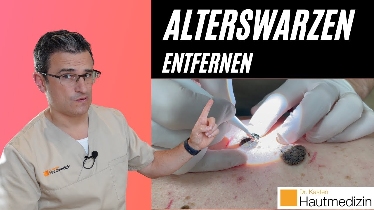 Welcher Hautarzt Nimmt Noch Patienten Auf Alterswarzen (seborrhoische Keratose) entfernen: Kürettage und