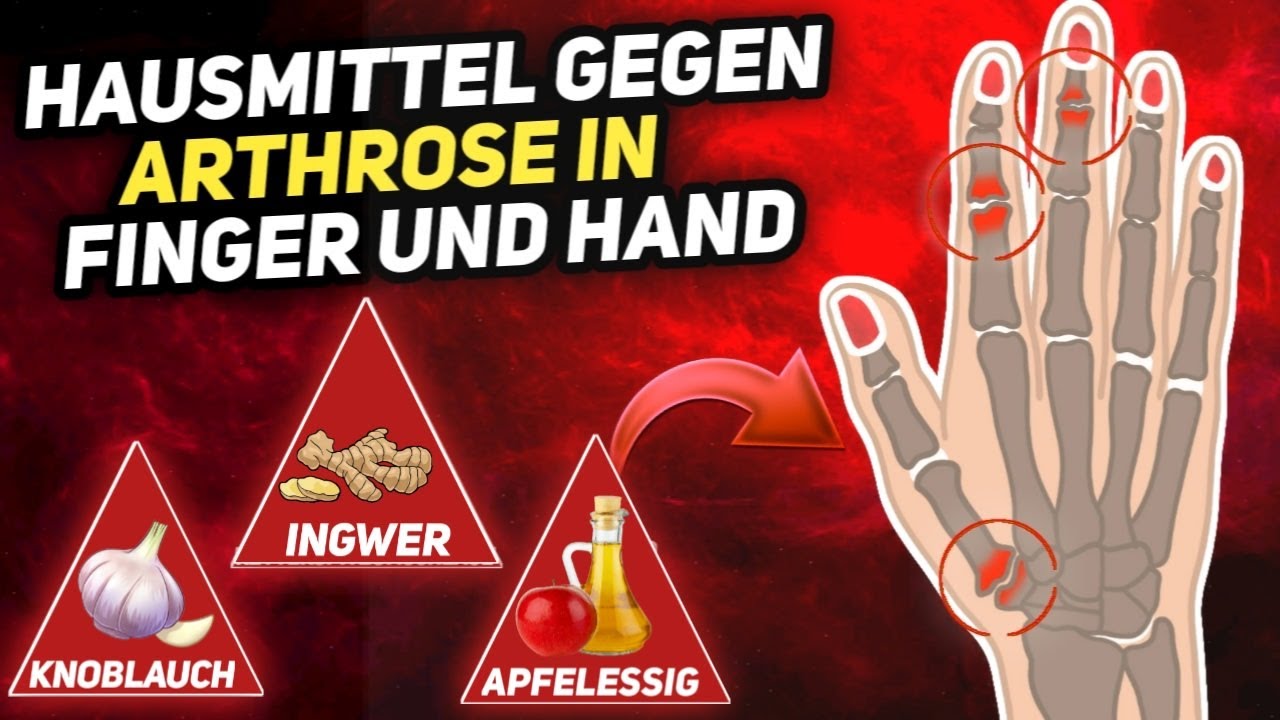 Facharzt Für Arthrose In Der Nähe Arthritis Finger Vorbeugen at Ruben Best blog