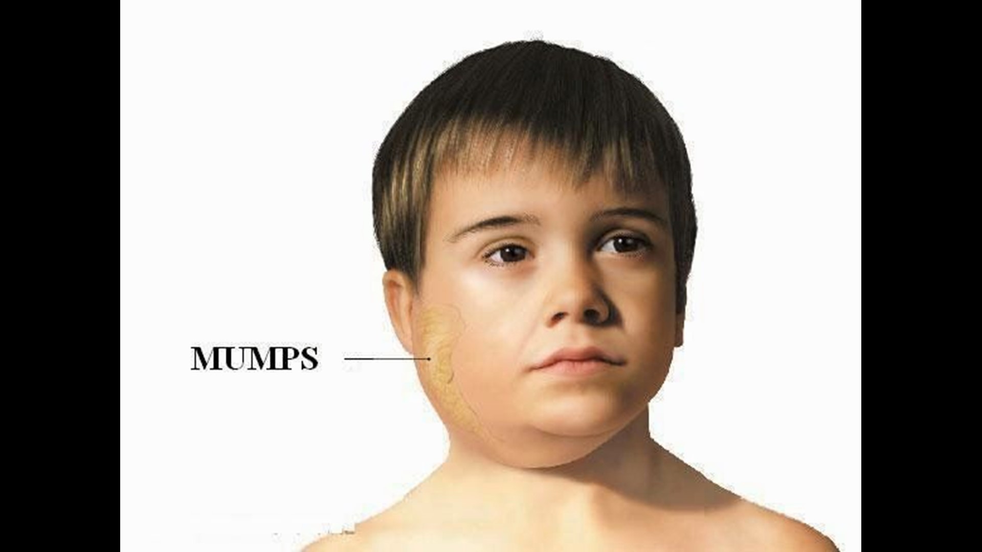 Mumps Masern Röteln Impfung Ansteckend Biggest mumps outbreak in 22 years occurring in Texas | newswest9.com