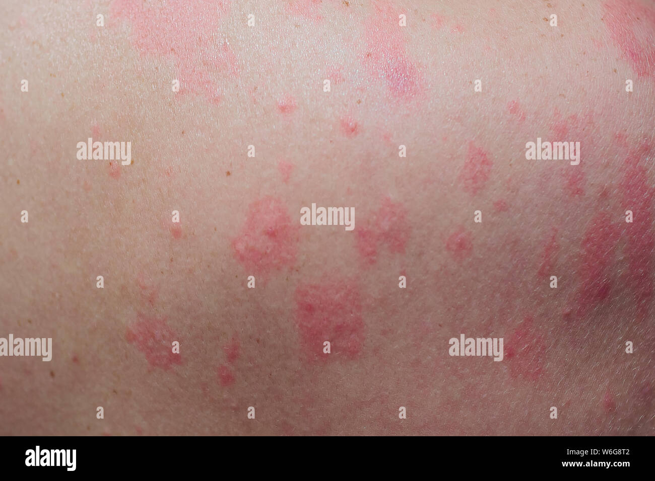 Ausschlag Hand Mund Fuß Krankheit Close up Allergie Hautausschlag, um die Rückseite des menschlichen mit