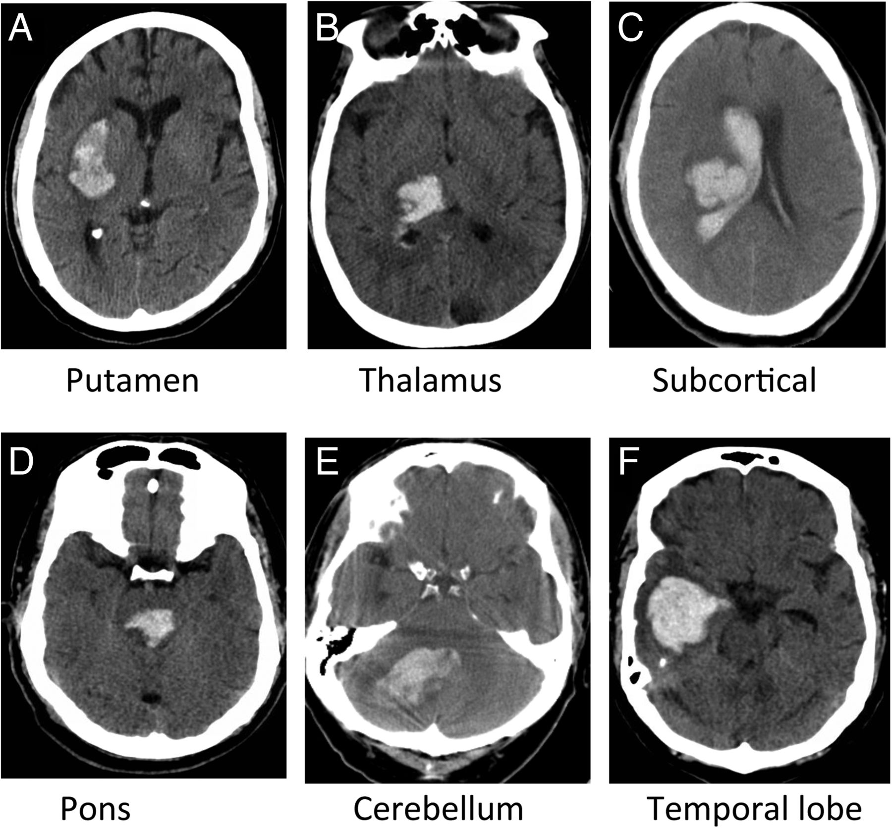 Ich Du Wir Projekt Im Kindergarten Current management of spontaneous intracerebral haemorrhage | Stroke