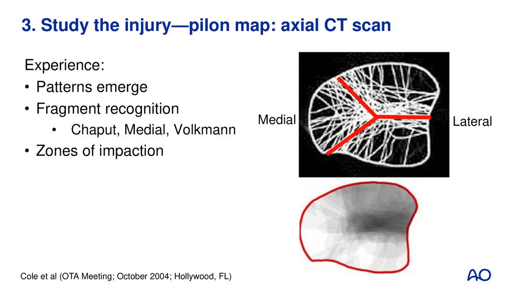 Orthopädikum Neuer Wall - Ihr Orthopädiezentrum In Hamburg Rezensionen Distal tibial fractures - ppt download