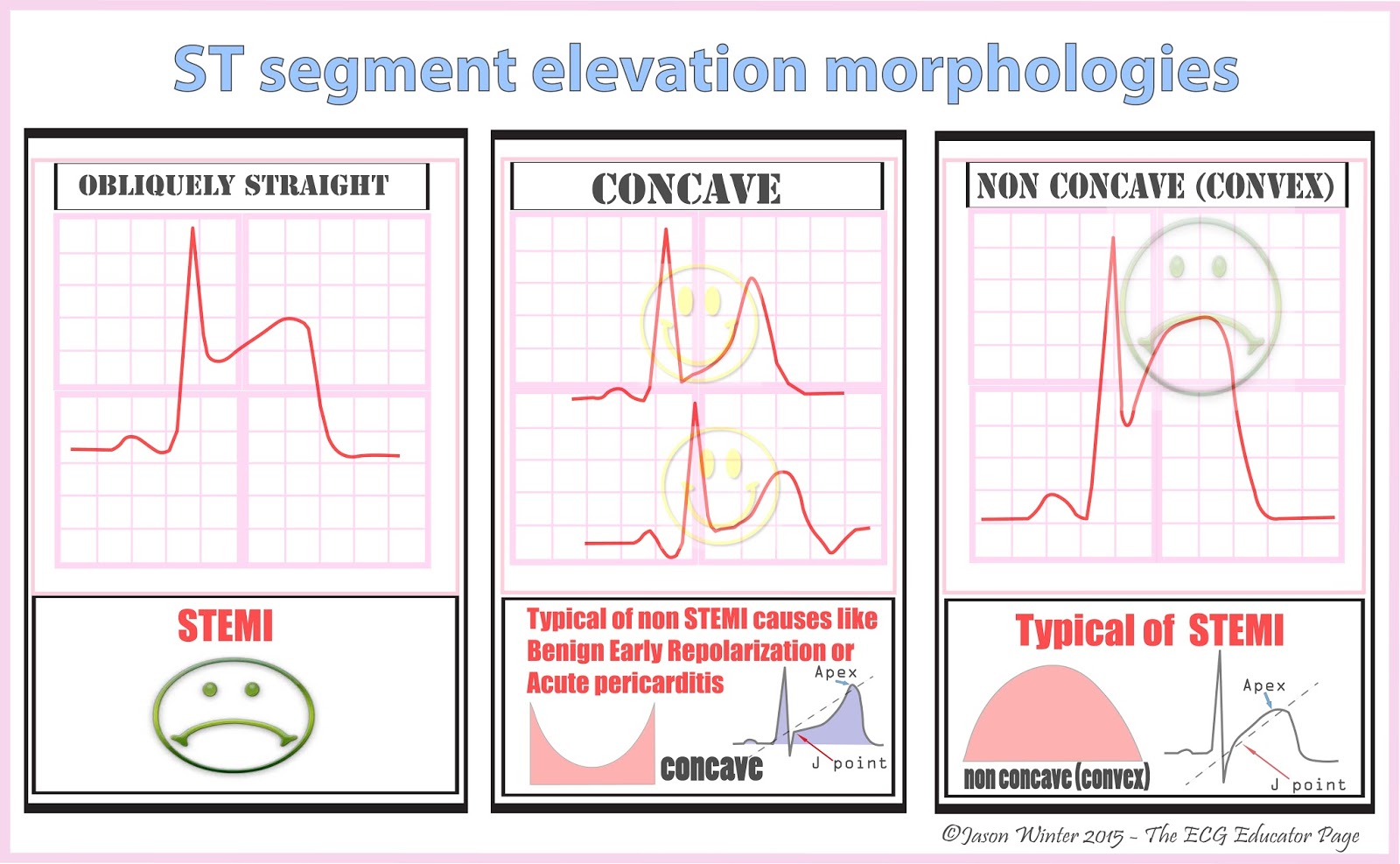 Ständegesellschaft Im Mittelalter 7. Klasse ECG Educator Blog : ST Segment Elevation Morphologies