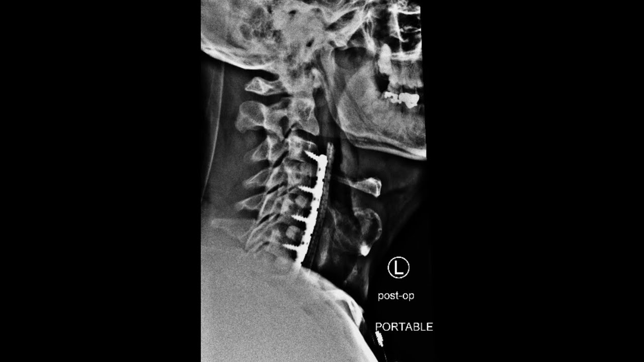 Schwerpunktpraxis Für Phoniatrie Und Pädaudiologie Dr. Blaukat Four Level Fusion ACDF C3-C7: Day 11 Post Surgery - YouTube
