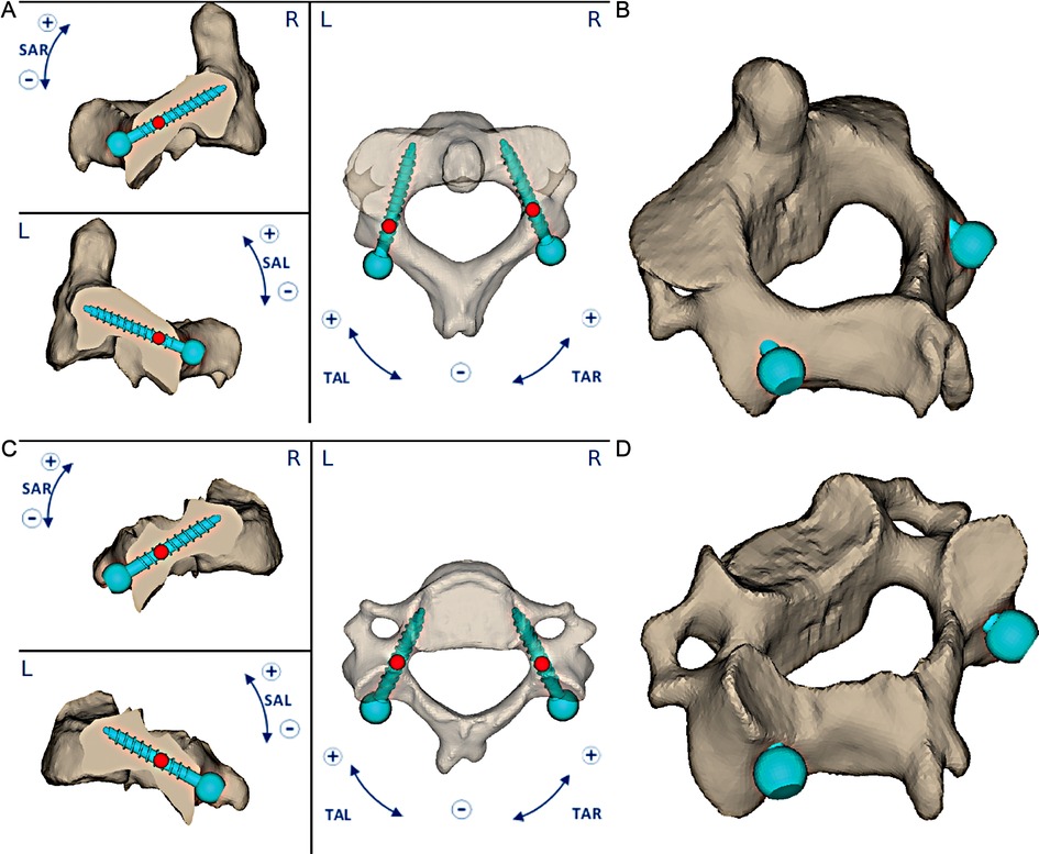 özgür Dogan Orthopädie & Unfallchirurgie Frankfurt Am Main Frontiers | 3D-printed guides for cervical pedicle screw placement in