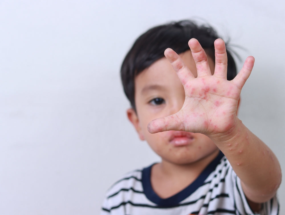 Mund Hand Fuß Krankheit Inkubationszeit Hand, Foot, and Mouth Disease (HFMD) Guide