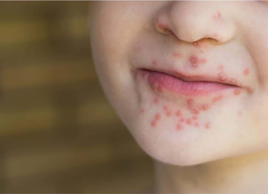 Hand Mund Fuß Was Ist Das Hand Foot And Mouth Disease On Face - vrogue.co