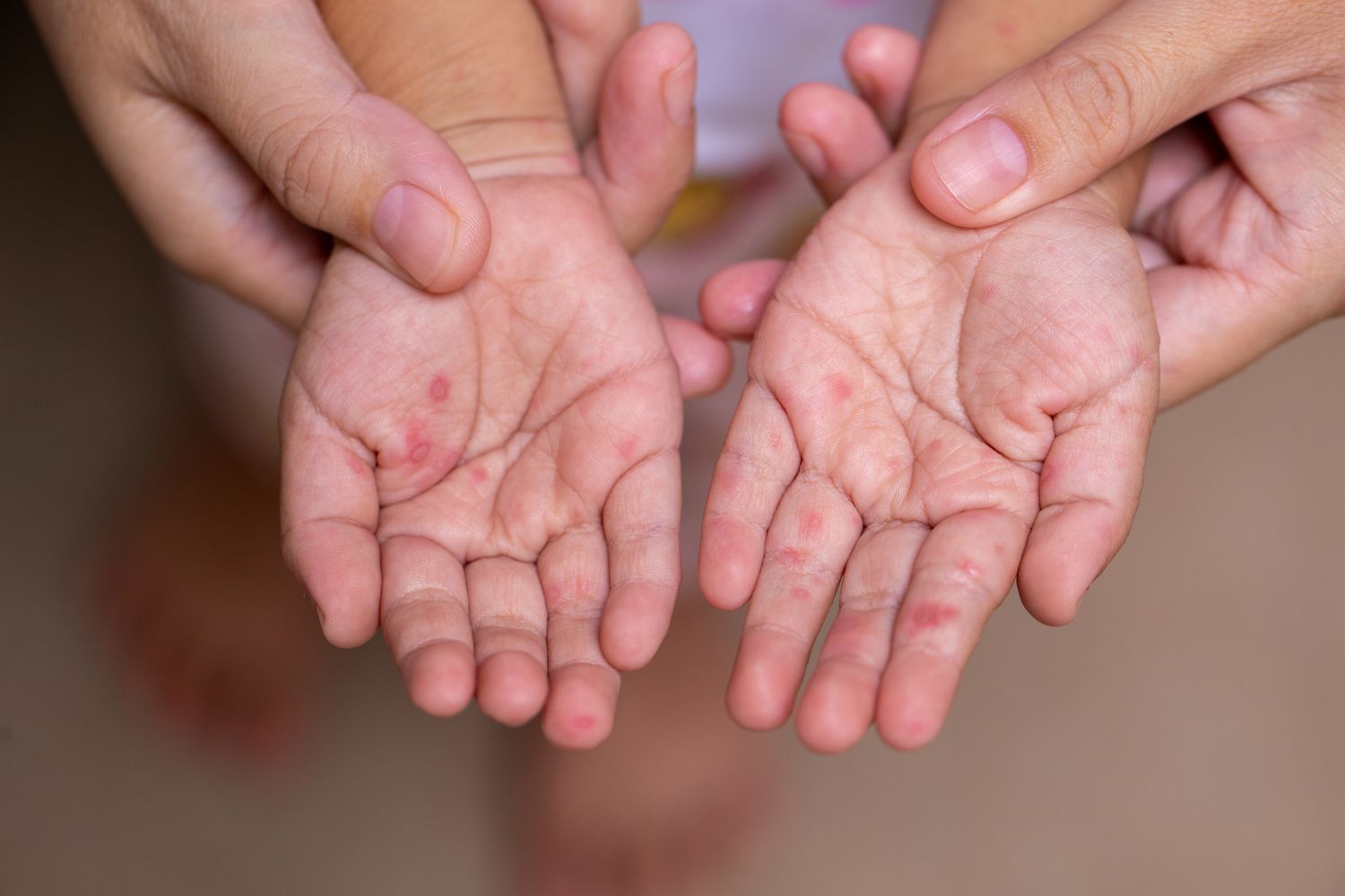 Ist Hand Mund Fuß Für Erwachsene Ansteckend