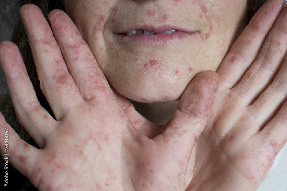 Ist Hand Mund Fuß Für Erwachsene Ansteckend Hand Fuß Mund Krankheit, Erwachsene Stock Photo | Adobe Stock