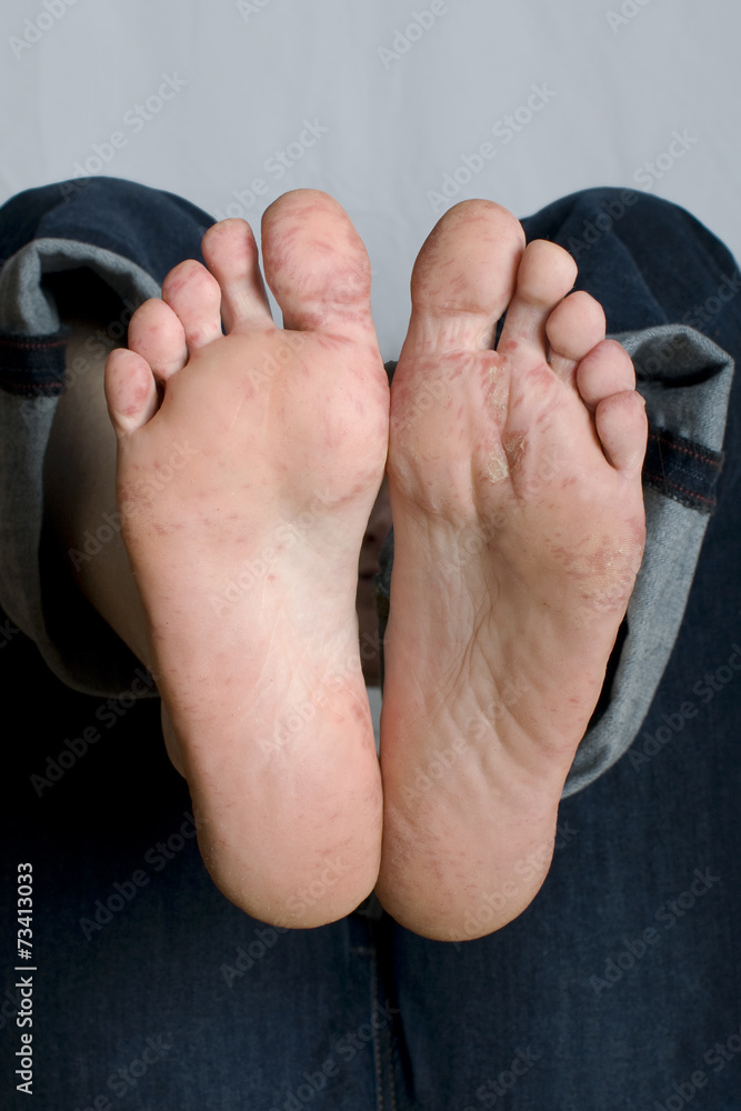 Ist Hand Mund Fuß Für Erwachsene Ansteckend Hand-Fuß-Mund-Krankheit, Füße Stock Photo | Adobe Stock