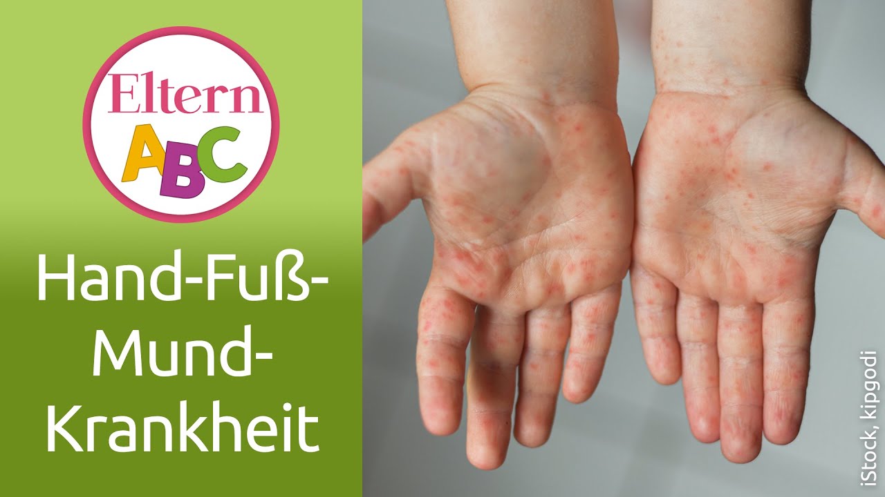 Symptome Hand Mund Fuß Erwachsene Hand-Fuß-Mund-Krankheit | Kleinkind | Eltern ABC | ELTERN