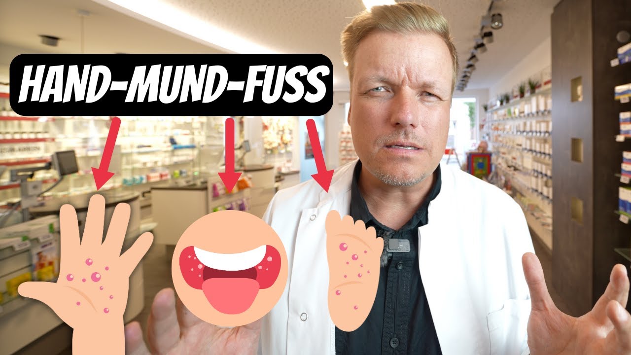 Hand Mund Fuß Krankheit Ansteckungsdauer Hand-Mund-Fuss-Krankheit - Wann ist es kritisch? - YouTube