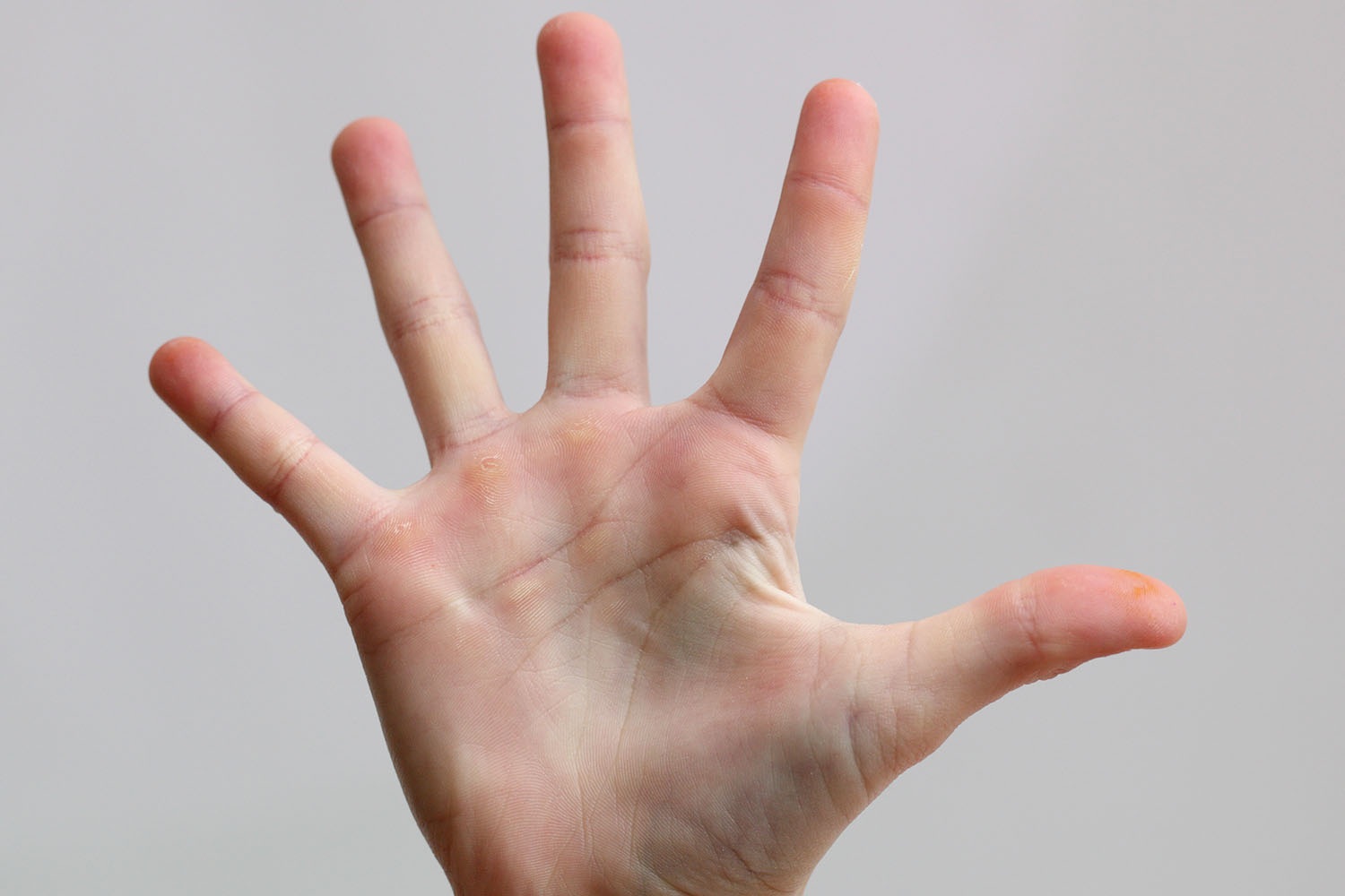 Hand Mund Fuß Nicht Mehr Ansteckend Hand Parts Name - Eremedium