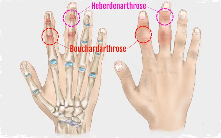 Facharzt Für Arthrose In Der Nähe Heberden Arthrose Finger
