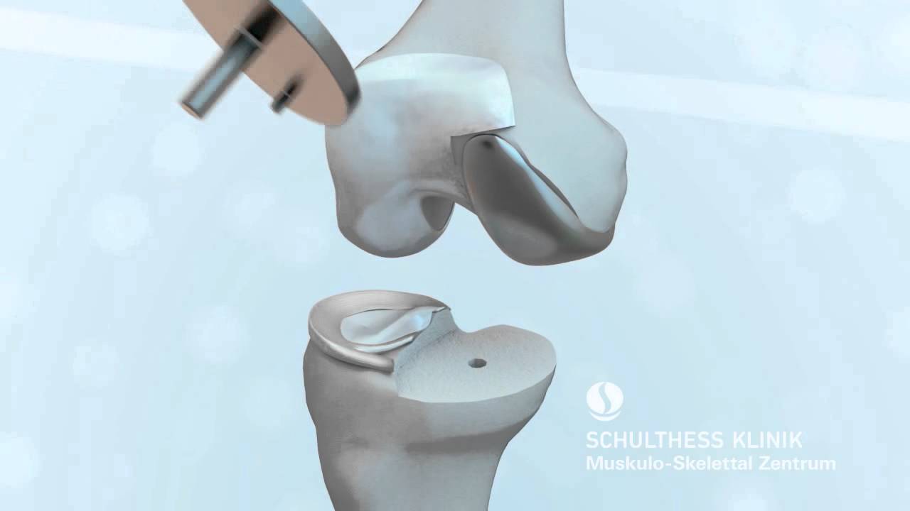 Beste Klinik Für Knie Op In Thüringen «Knieprothese» - Schulthess Klinik - YouTube