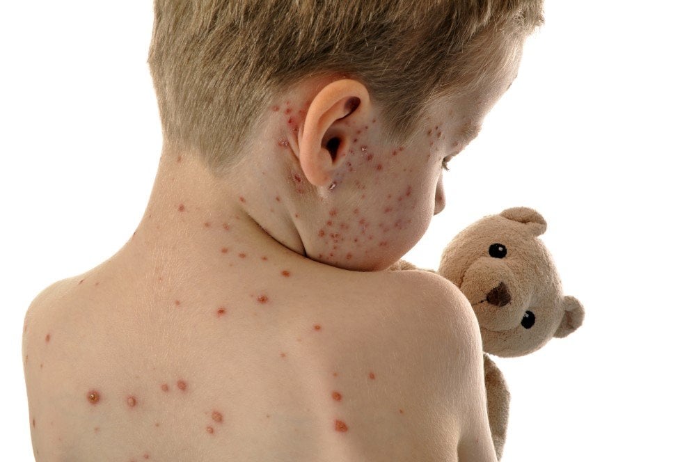 Masern Mumps Röteln Impfung Ansteckend