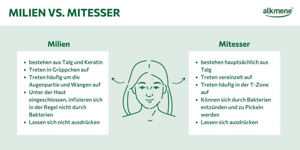 Milien Entfernen Kosmetikerin In Der Nähe Milien: Ursachen kennen und Hautgrieß vorbeugen - alkmene