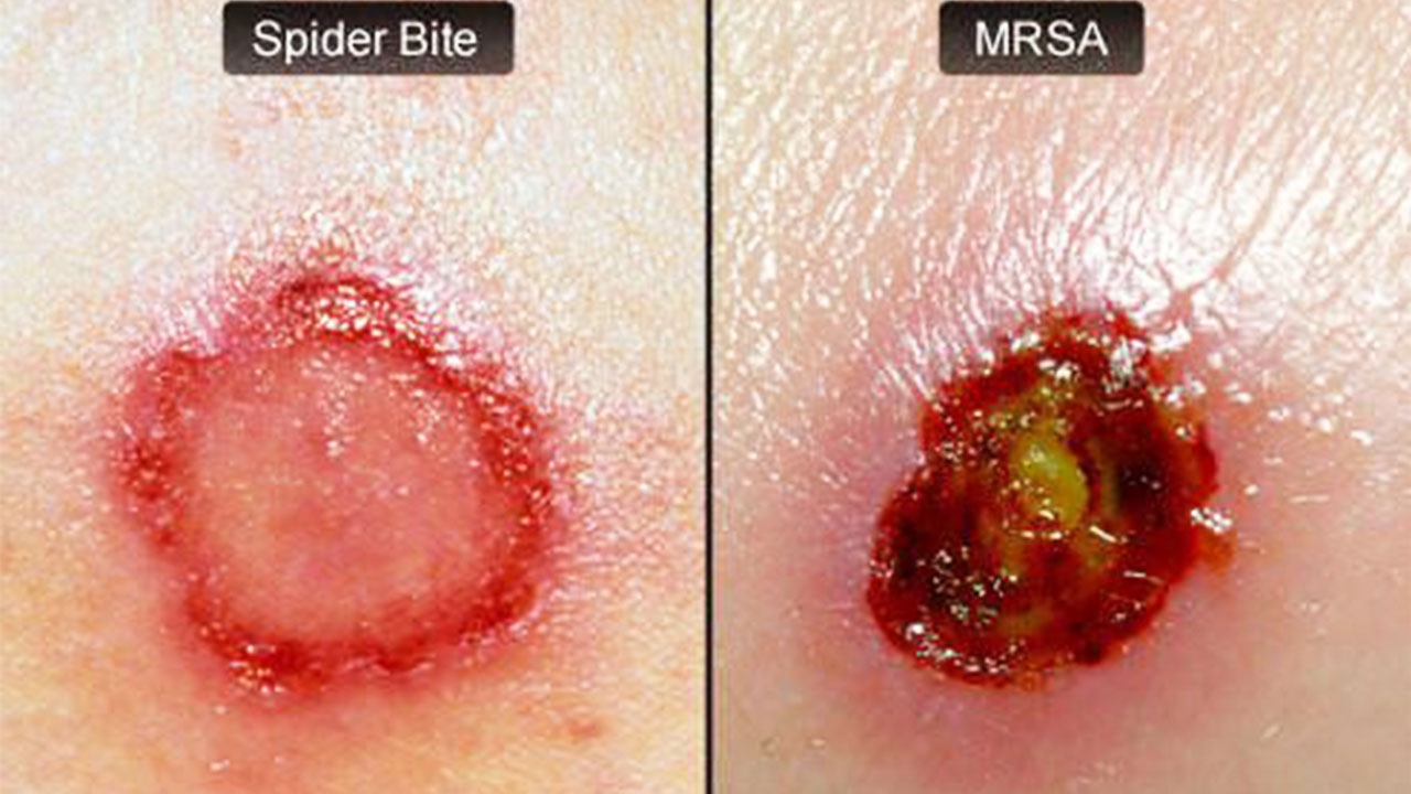 Darf Ich Mit Mrsa Arbeiten Gehen Mrsa.exe
