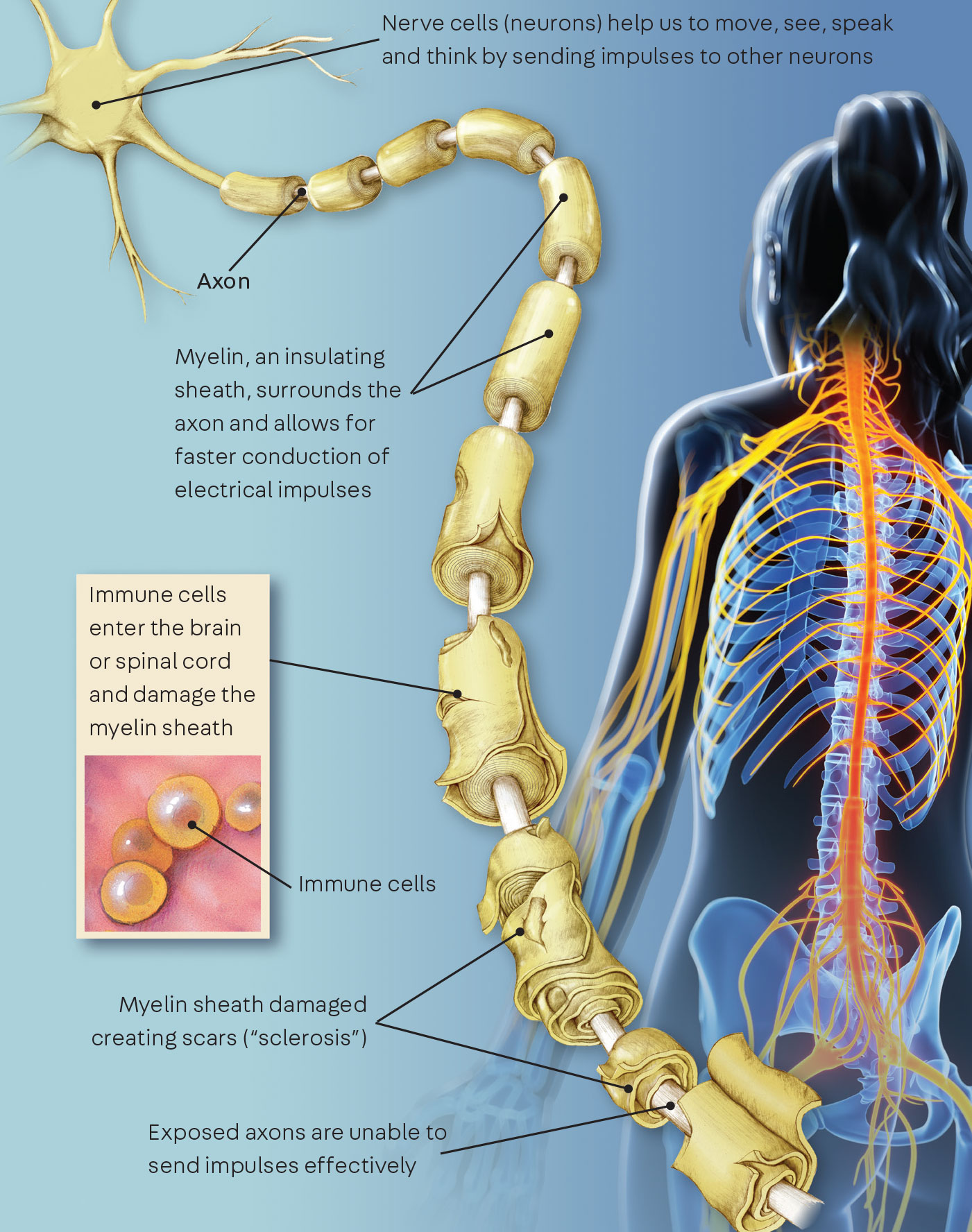 Ms Reisemobile Gmbh Im Derdel Münster Multiple Sclerosis Patient