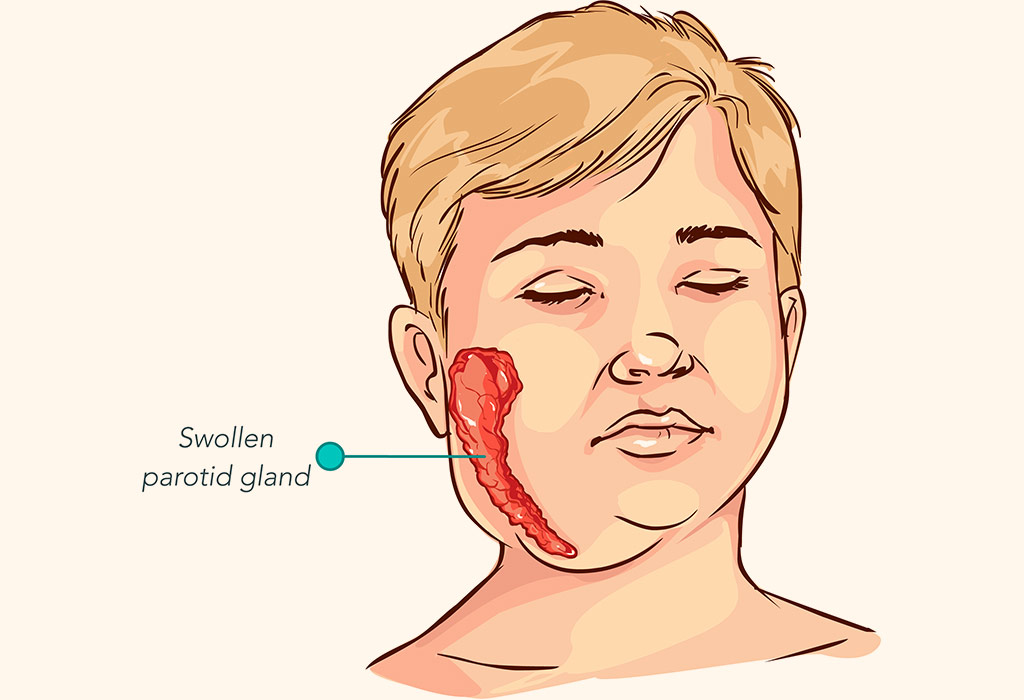 Mumps Masern Röteln Impfung Ansteckend Mumps in Kids – Reasons, Signs & Treatment