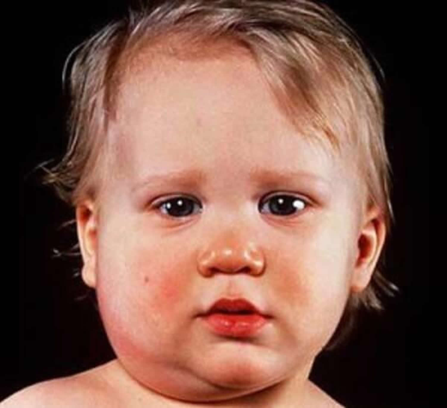 Mumps Masern Röteln Impfung Ansteckend