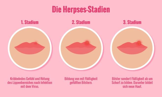 Ringelröteln Ab Wann Nicht Mehr Ansteckend