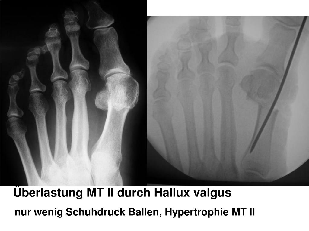 Orthopäde Ohne Termin In Der Nähe PPT - bei Hallux valgus Überlastung II – III - PowerPoint Presentation