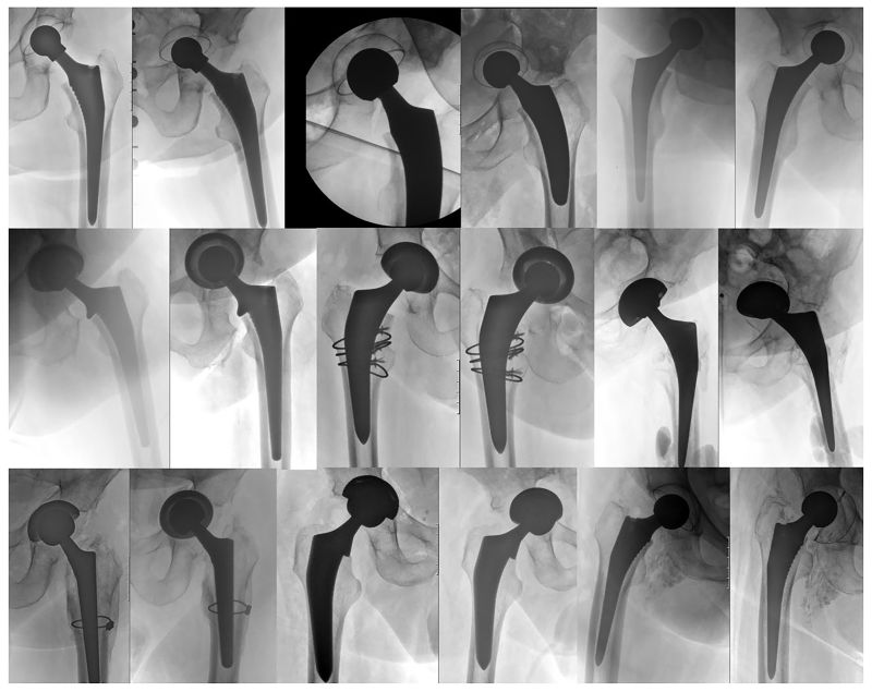 Orthopädie Lörrach Dr. Med. Jörg Bosch & Wolfgang Schareck Prof. Dr. med. J. D. Bastian on LinkedIn: Failure of primary THA