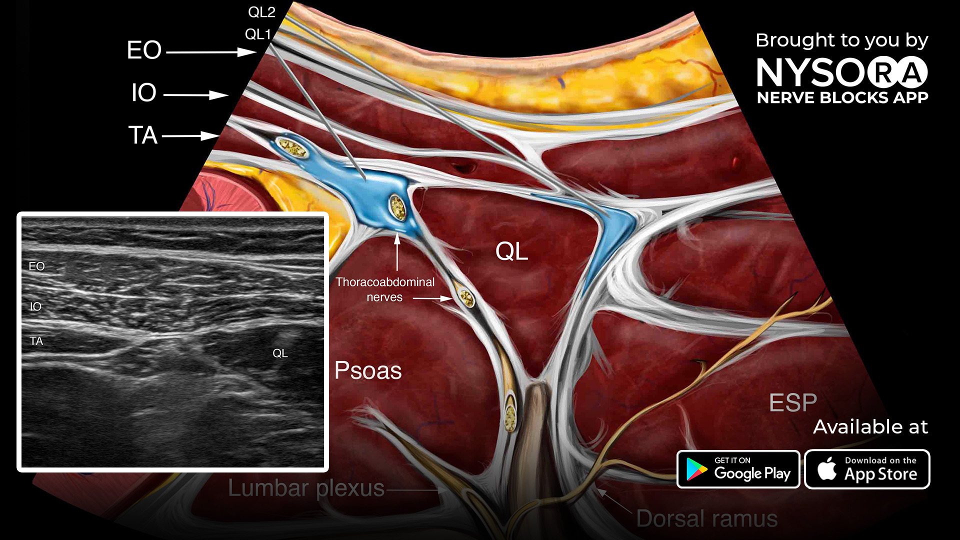 Block House Am Aegi Hildesheimer Straße Hannover Quadratus Lumborum Block Ultrasound Nysora