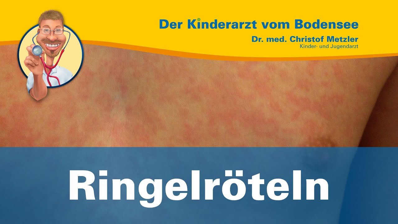 Ringelröteln Wann Nicht Mehr Ansteckend Ringelröteln - Der Kinderarzt vom Bodensee - YouTube