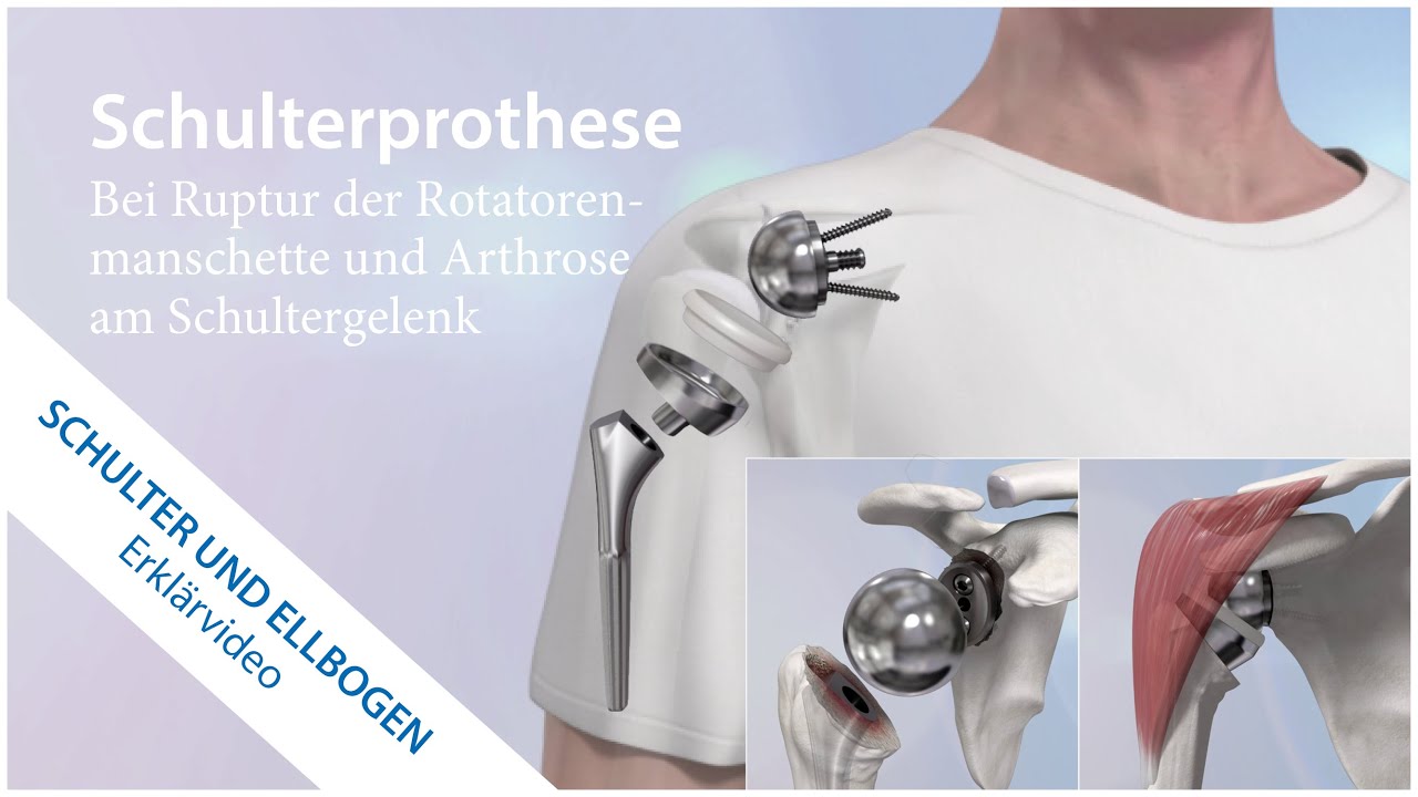 Orthopäde Für Schulter In Der Nähe Schulterprothese bei Arthrose am Schultergelenk - YouTube