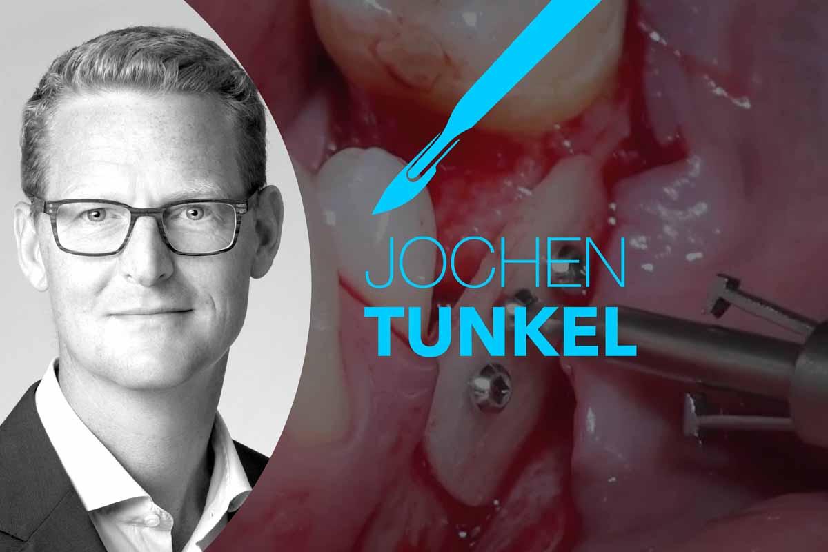 Gemeinschaftspraxis Dr. Michael Lampe & Dr. Christine Tunkel Surgery by Dr. Jochen Tunkel – maxgraft® cortico - SURGERY - botiss