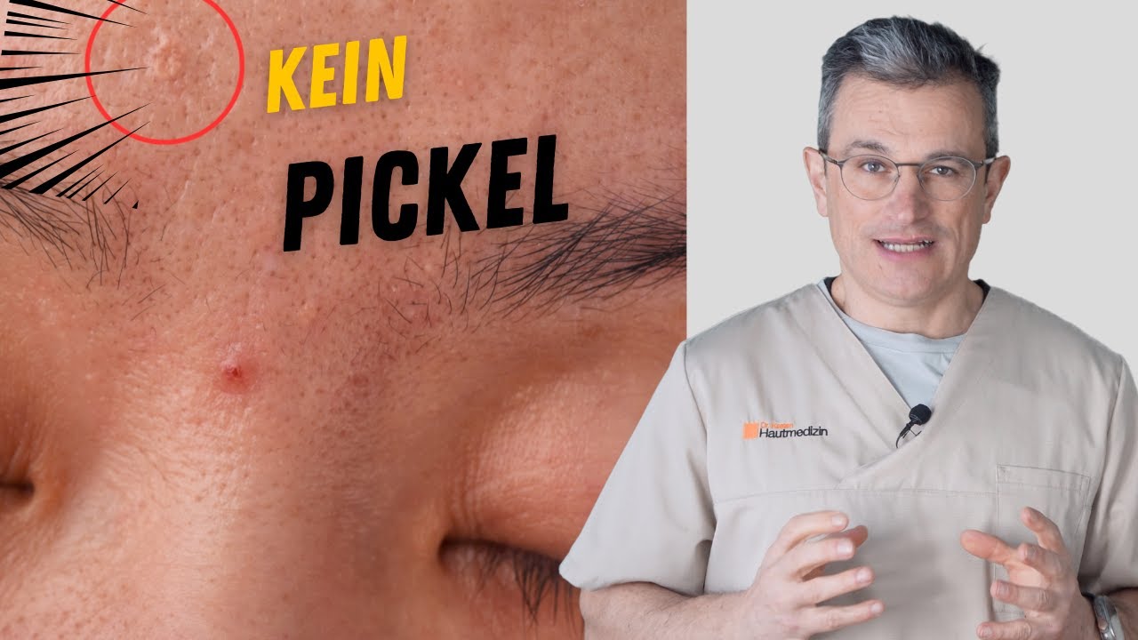 Welcher Hautarzt Nimmt Noch Patienten Auf Talgdrüsenhyperplasie erkennen und entfernen. Dr. Kasten Hautarzt in