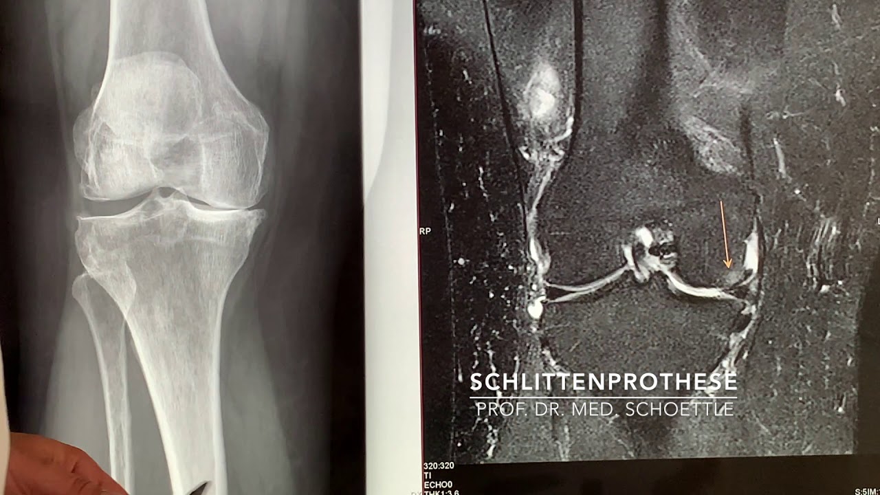 Beste Klinik Für Knie Op In Thüringen Teilprothese am Knie - Schlittenprothese - Prof. Dr. med. Philip
