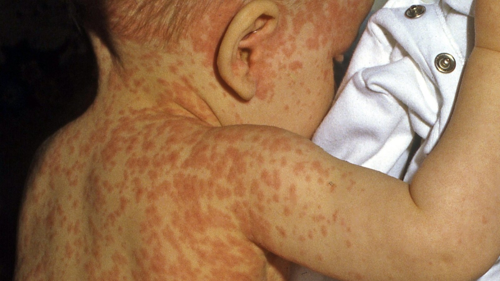Masern Mumps Röteln Impfung Ansteckend Was Sie über die Masern wissen sollten