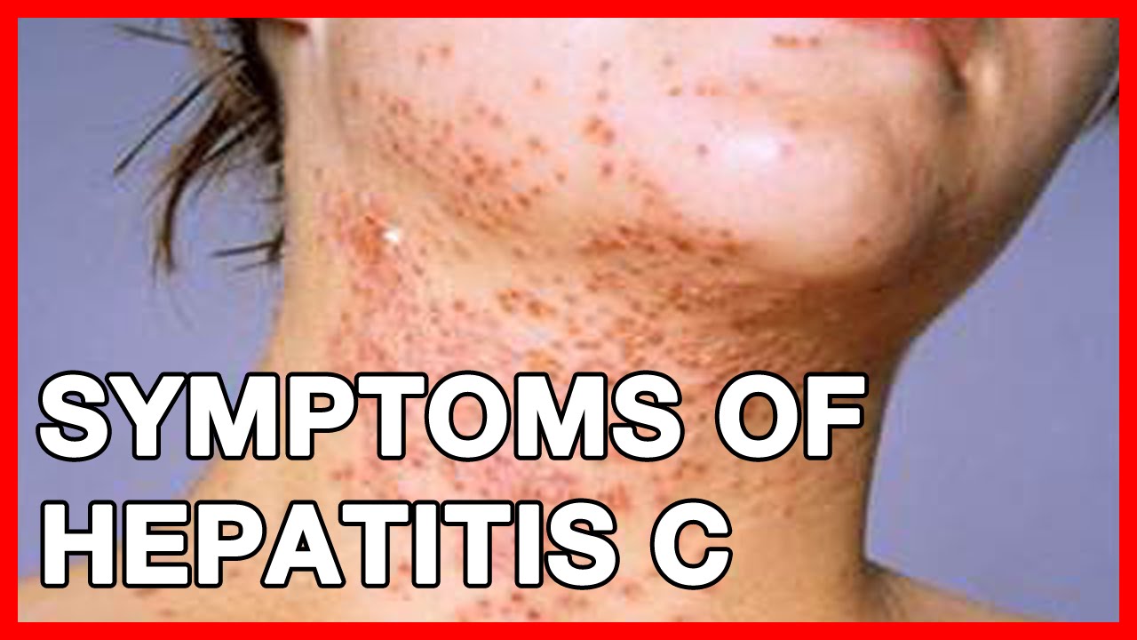 Wie Schlimm Ist Hep C What is Hepatitis C? Is it a STD? Transmission, vaccine and Symptoms