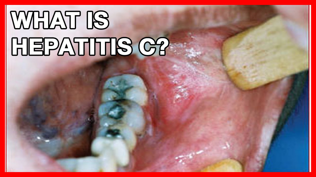 Wie Schlimm Ist Hep C