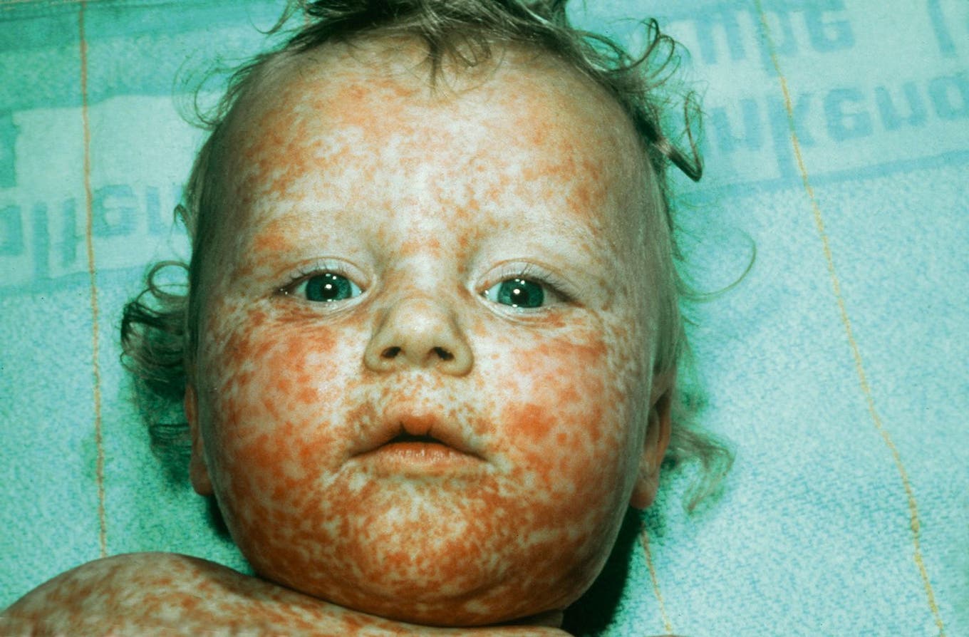 Masern Mumps Röteln Impfung Ansteckend WHO warnt vor Masernwelle in Europa